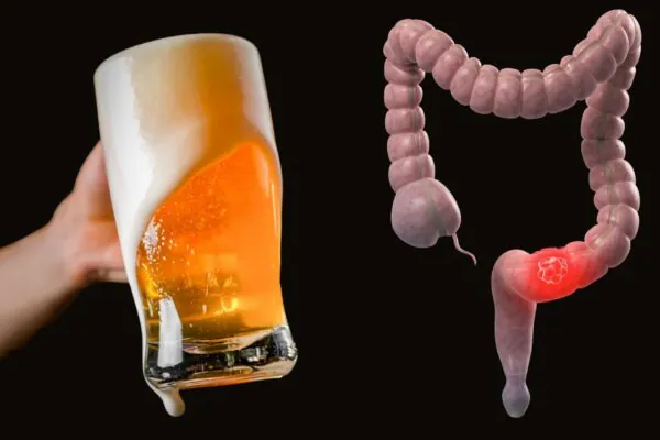 Consumo prolongado de álcool eleva risco de câncer retal. (Foto: Getty Images e Photo Library via Canva)