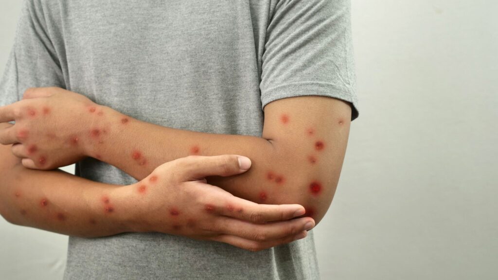 Contato com lesões e objetos pode transmitir Mpox. (Foto: Getty Images via Canva)