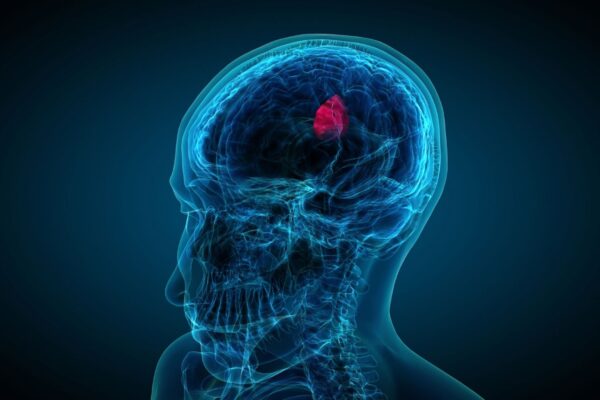 Nova tecnologia identifica células resistentes do glioblastoma. (Foto: Getty Images via Canva)