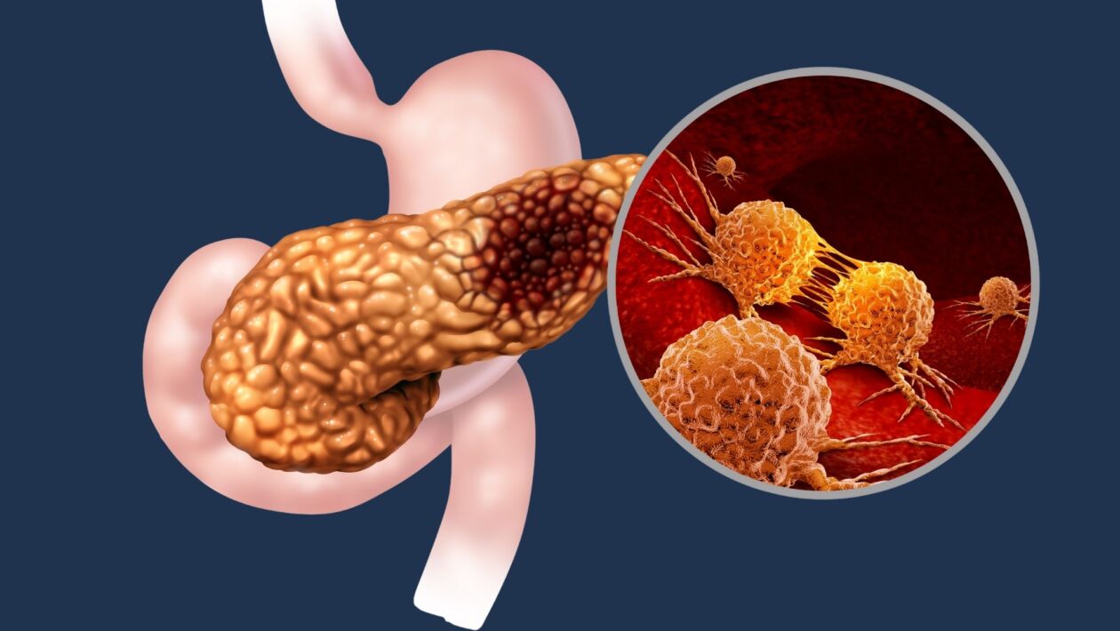 Terapia combinada elimina tumor pancreático em testes. (Foto: Getty Images via Canva)
