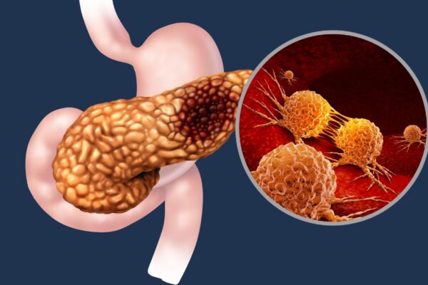 Terapia combinada elimina tumor pancreático em testes. (Foto: Getty Images via Canva)