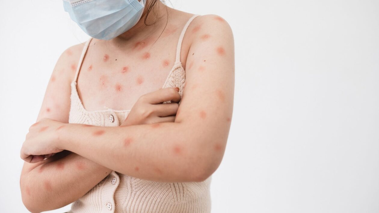 MG confirma três casos de Mpox em 2026. (Foto: Getty Images via Canva)