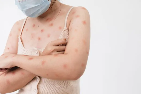 MG confirma três casos de Mpox em 2026. (Foto: Getty Images via Canva)