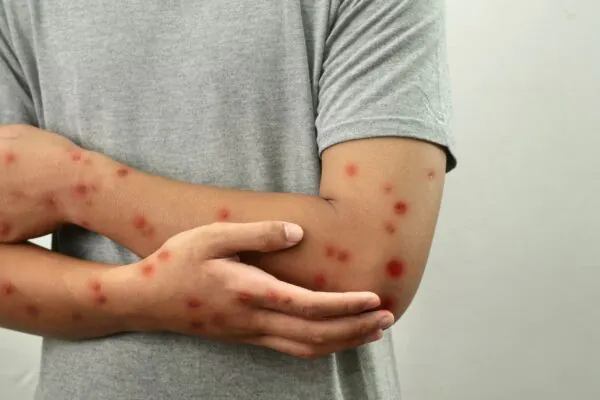 Lesões na pele são o principal sinal clínico da Mpox. (Foto: Getty Images via Canva)