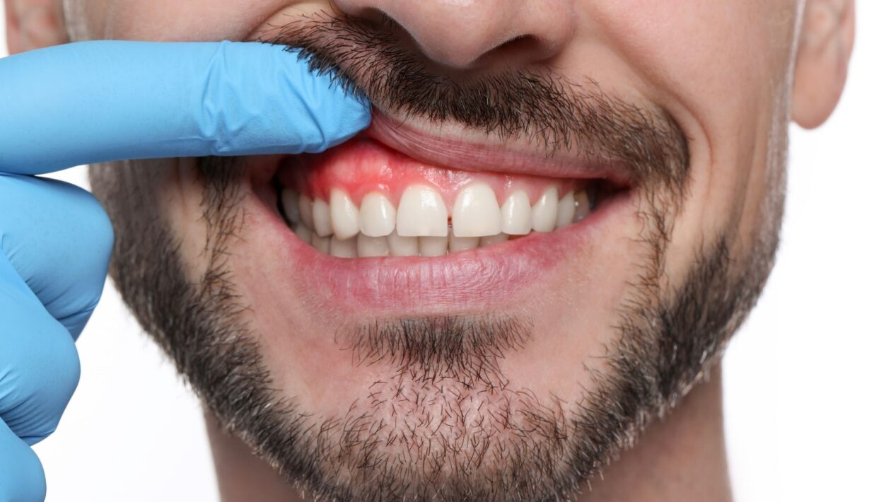 Morina tem ação antimicrobiana contra infecções gengivais. (Foto: Africa Images via Canva)