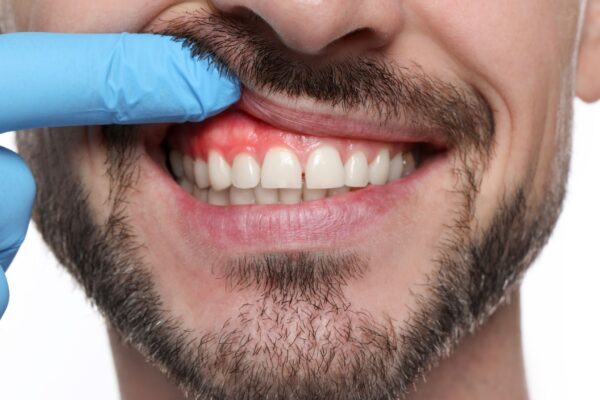 Morina tem ação antimicrobiana contra infecções gengivais. (Foto: Africa Images via Canva)