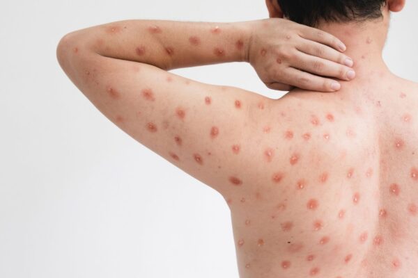 Mpox cresce no Brasil e acende alerta sanitário. (Foto: Getty Images via Canva)