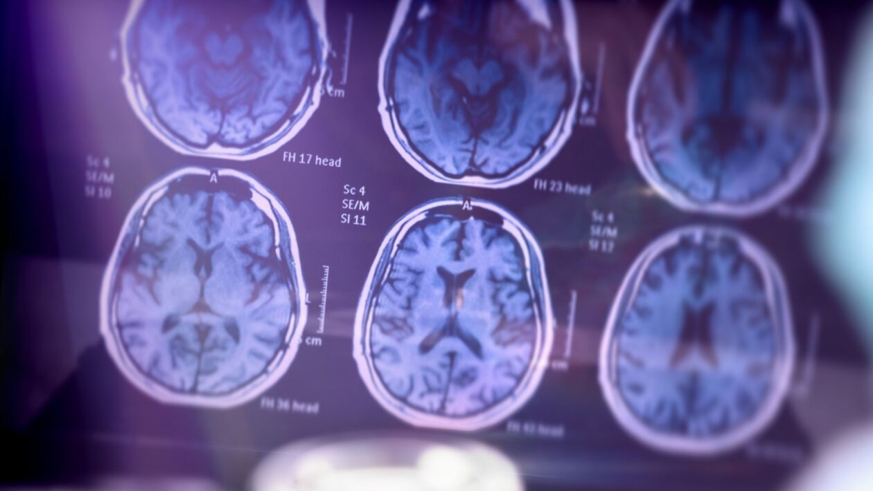Estudo mostra como estimular a defesa cerebral no Alzheimer. (Foto: Getty Images via Canva)