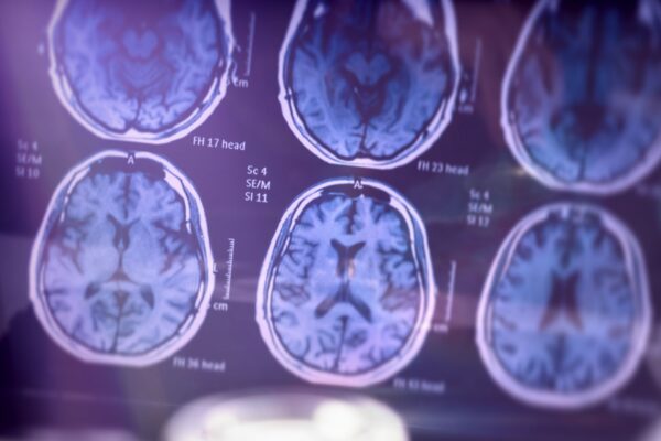 Estudo mostra como estimular a defesa cerebral no Alzheimer. (Foto: Getty Images via Canva)