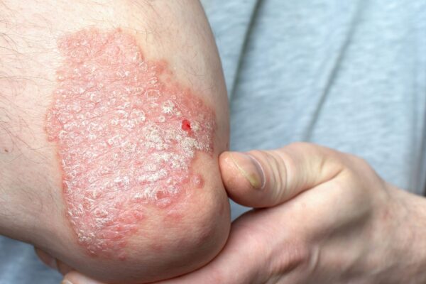 Psoríase pode avançar da pele para as articulações. (Foto: Getty Images via Canva)