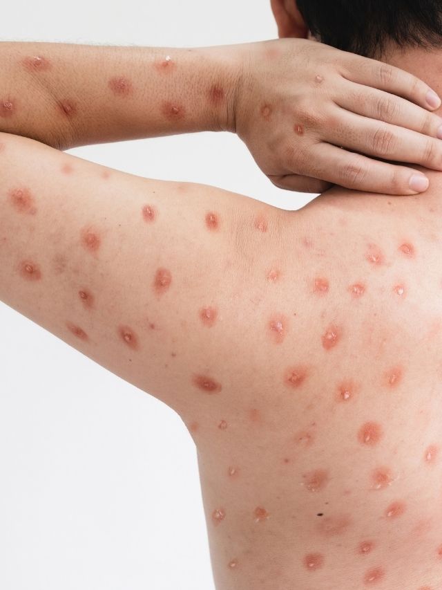 Atenção ao Mpox: saiba como se prevenir