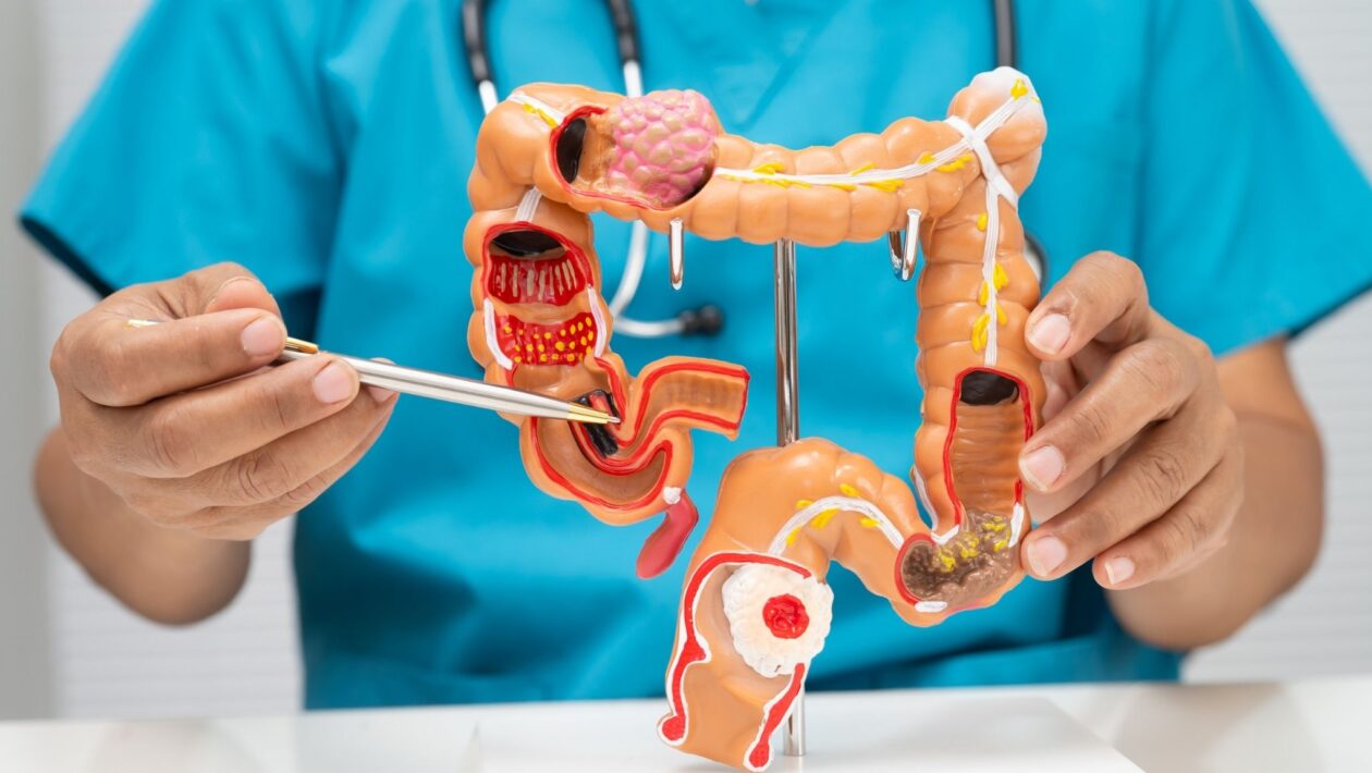 Hábitos modernos elevam risco de câncer colorretal. (Foto: Pamai's Images via Canva)