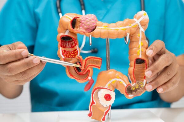 Hábitos modernos elevam risco de câncer colorretal. (Foto: Pamai's Images via Canva)