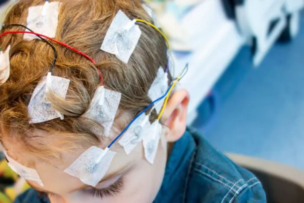Novo remédio pode reduzir crises de epilepsia resistente. (Foto: Getty Images via Canva)