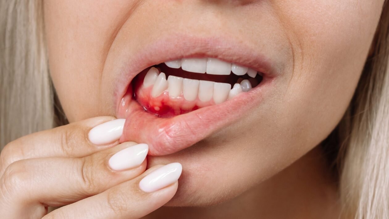Gengiva inflamada pode afetar o fígado. ( Getty Images via Canva)
