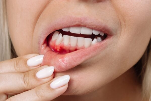 Gengiva inflamada pode afetar o fígado. ( Getty Images via Canva)