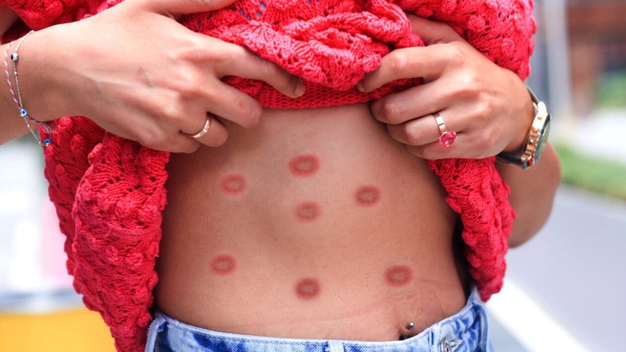 Mpox pode se tornar grave em grupos vulneráveis. (Foto: Getty Images via Canva)