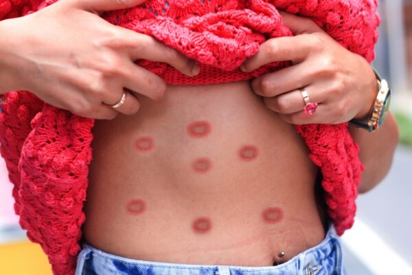 Mpox pode se tornar grave em grupos vulneráveis. (Foto: Getty Images via Canva)