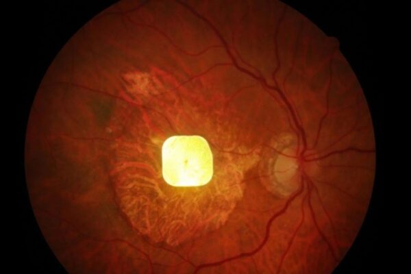 Retina de um participante após o implante. (Foto: Science Corporation)