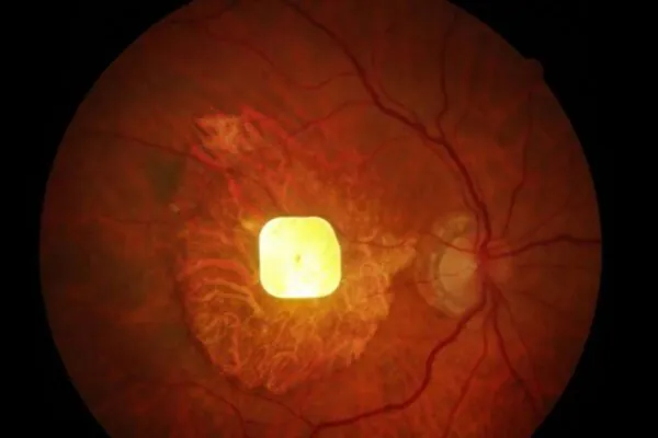 Retina de um participante após o implante. (Foto: Science Corporation)