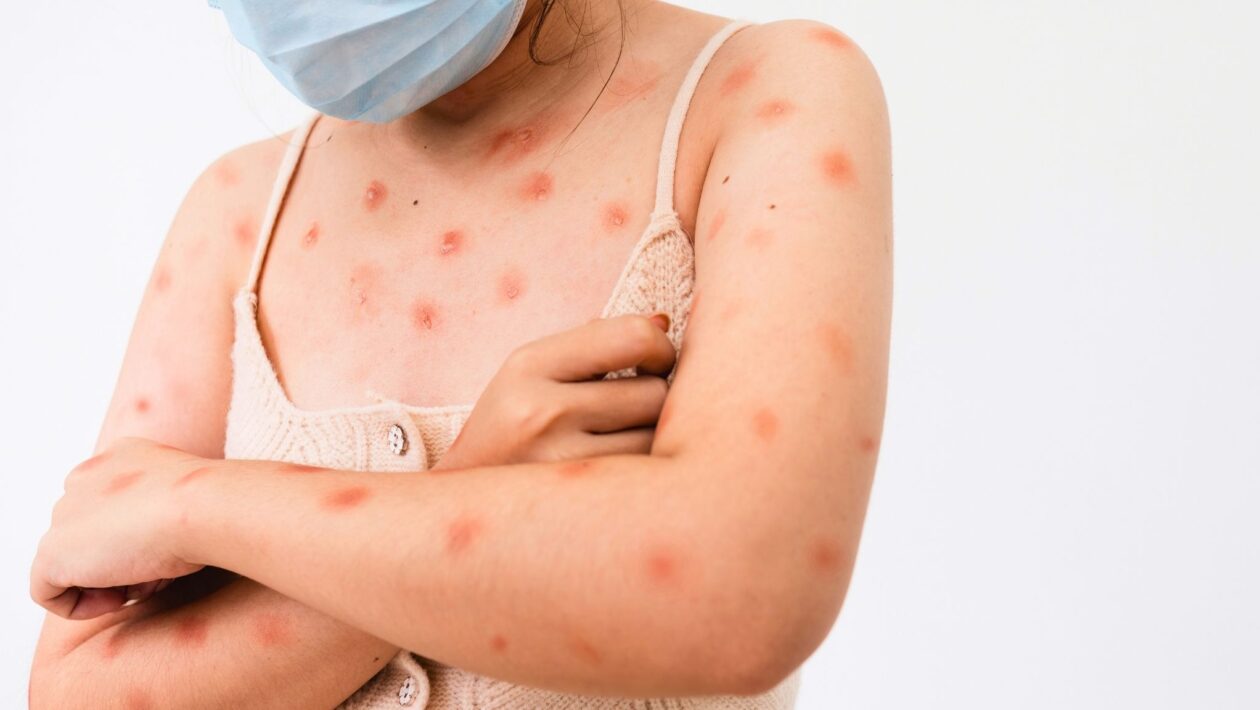 Ceará confirma 2º caso de mpox em 2026. (Foto: Getty Images via Canva)