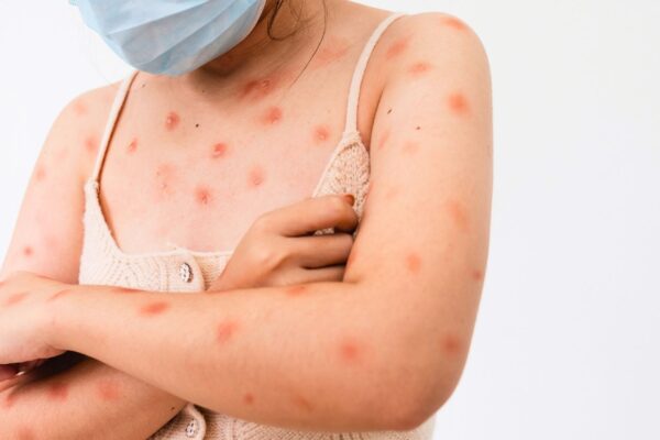 Ceará confirma 2º caso de mpox em 2026. (Foto: Getty Images via Canva)