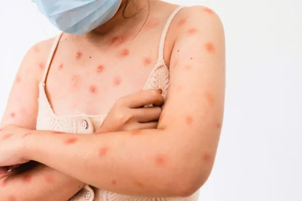 Ceará confirma 2º caso de mpox em 2026. (Foto: Getty Images via Canva)