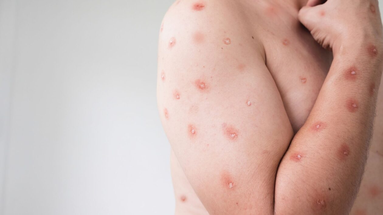 Mpox se expande por estados brasileiros e acende alerta. (Foto: Getty Images via Canva)