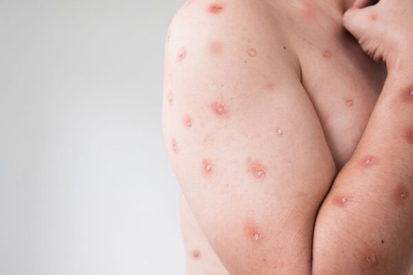 Mpox se expande por estados brasileiros e acende alerta. (Foto: Getty Images via Canva)