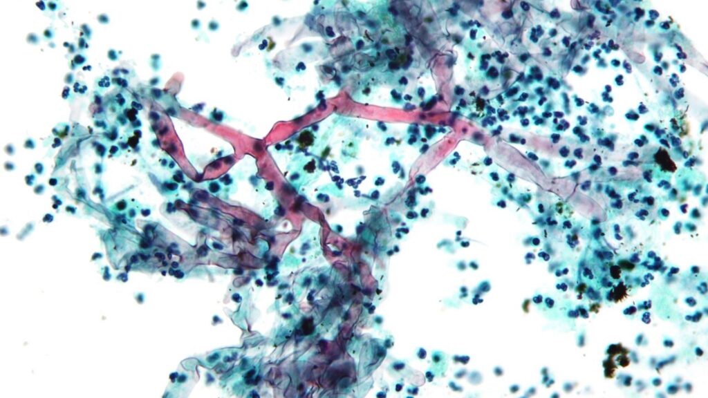 Micrografia de mucormicose em biópsia pulmonar; fungo afeta imunossuprimidos. (Foto: Néfron via Wikimedia Commons)