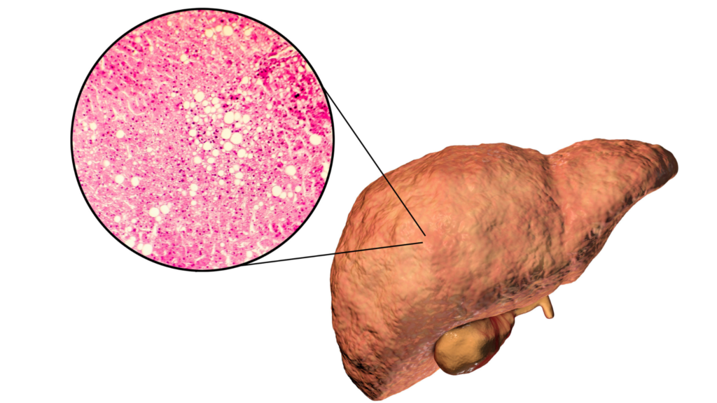 Variante genética MET eleva risco de doença hepática grave. (Foto: Science Photo Library via Canva)