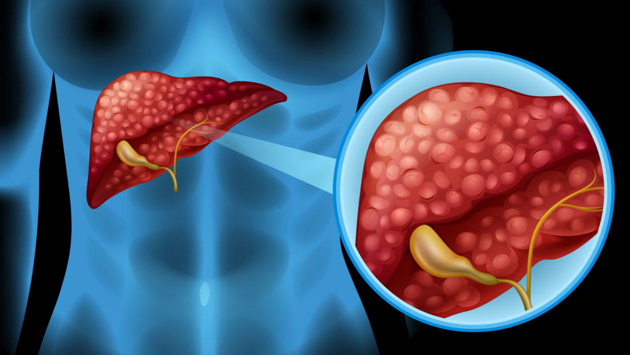Acúmulo de gordura no fígado pode ter origem genética. (Foto: Pixabay via Canva)