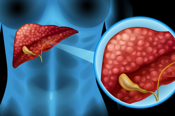 Acúmulo de gordura no fígado pode ter origem genética. (Foto: Pixabay via Canva)