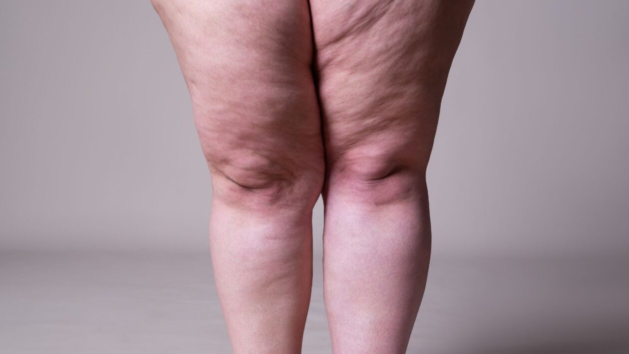 Lipedema causa dor, inchaço e hematomas. (Foto: Getty Images via Canva)