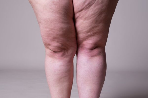 Lipedema causa dor, inchaço e hematomas. (Foto: Getty Images via Canva)