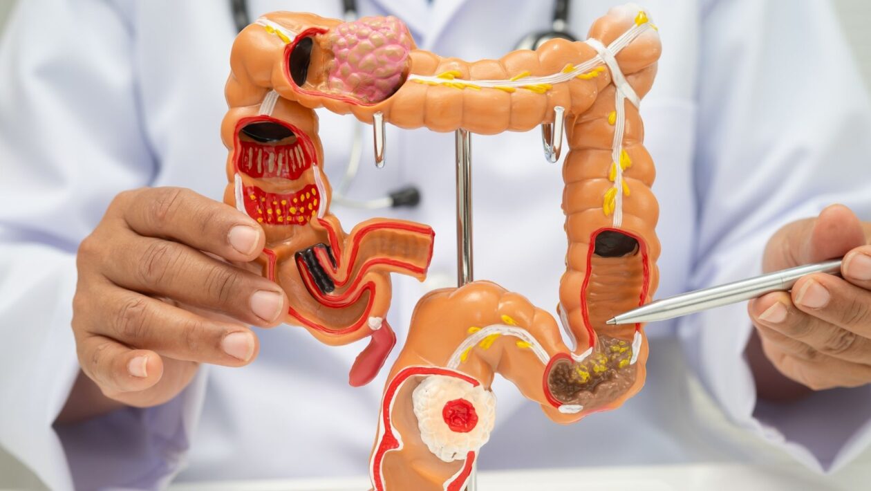 Colonoscopia detecta precocemente câncer colorretal. (Foto: Pamai's Images via Canva)