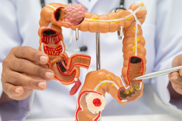 Colonoscopia detecta precocemente câncer colorretal. (Foto: Pamai's Images via Canva)