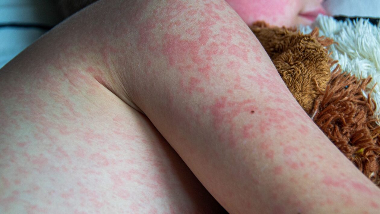 Bebê em São Paulo tem primeiro caso de sarampo de 2026. (Foto: Getty Images via Canva)