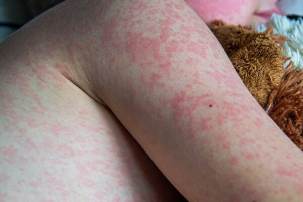 Bebê em São Paulo tem primeiro caso de sarampo de 2026. (Foto: Getty Images via Canva)