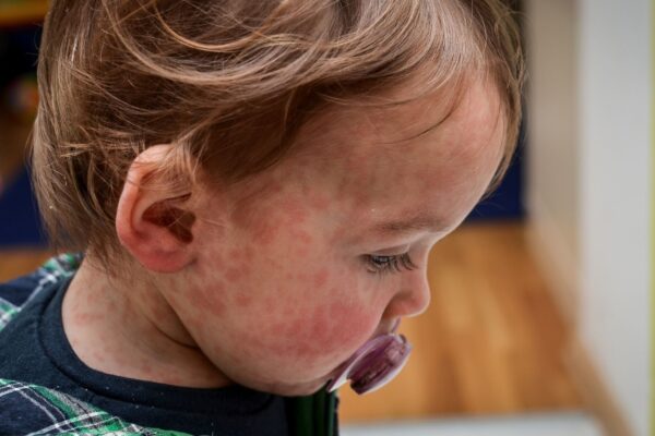 Sarampo ainda circula e exige alta vacinação. (Foto: Getty Images via Canva)