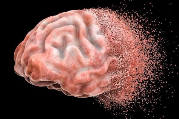 Nova técnica revela avanço do Alzheimer. (Foto: Getty Images via Canva)