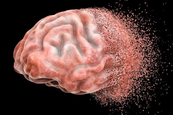 Nova técnica revela avanço do Alzheimer. (Foto: Getty Images via Canva)