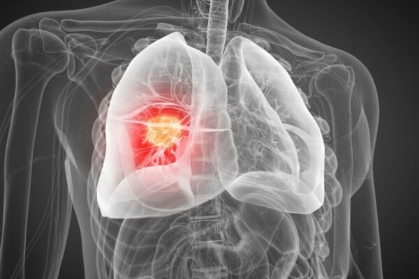 Rastreamento do câncer de pulmão ganha novas técnicas. (Foto: Science Photo Library via Canva)