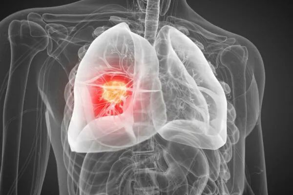 Rastreamento do câncer de pulmão ganha novas técnicas. (Foto: Science Photo Library via Canva)