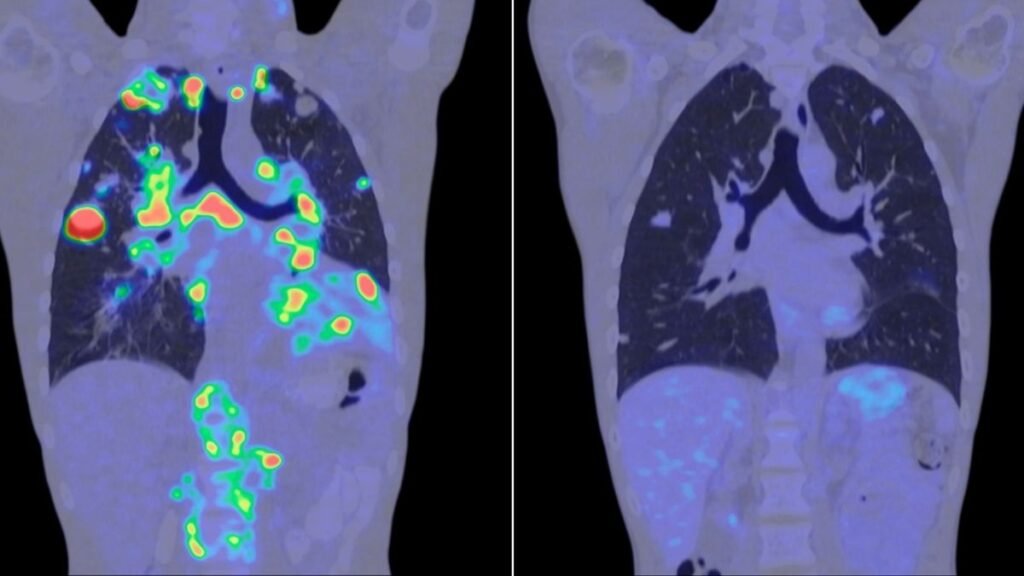 TC e PET mostra redução de metástases antes e depois do tratamento. (Foto: Science Photo Library via Canva)