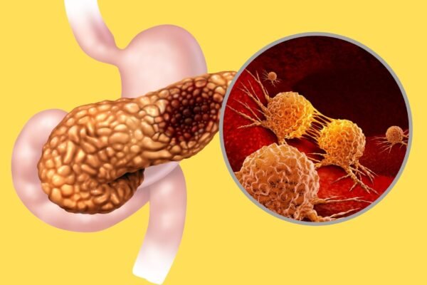 Novo alvo pode frear câncer pancreático. (Foto: Getty Images via Canva)