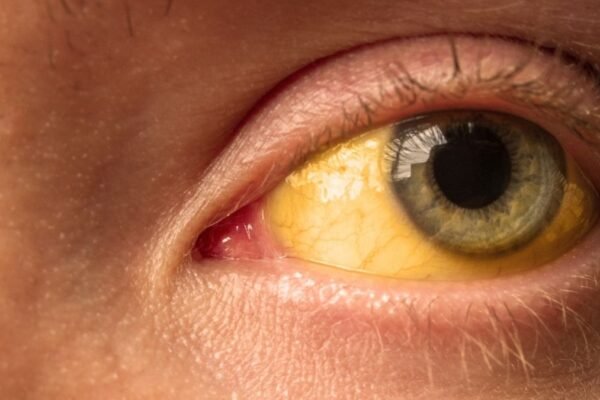 Icterícia pode indicar fase grave da febre amarela. (Foto: Getty Images via Canva)