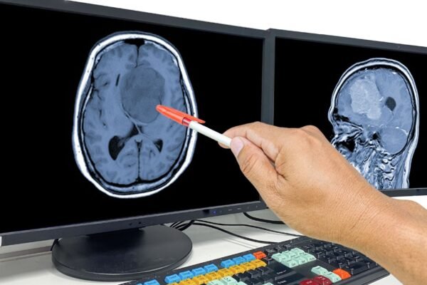 Diagnóstico de glioblastoma ainda traz grandes desafios. (Foto: Getty Images via Canva)