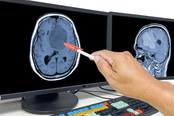 Diagnóstico de glioblastoma ainda traz grandes desafios. (Foto: Getty Images via Canva)