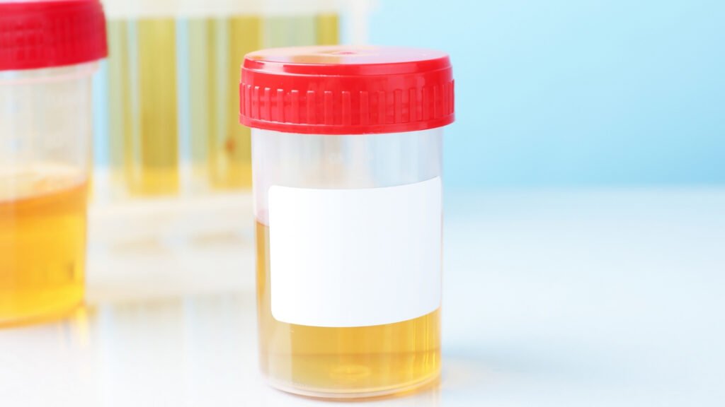 Infecção urinária pode ser tratada no mesmo dia. (Foto: Africa Images via Canva)